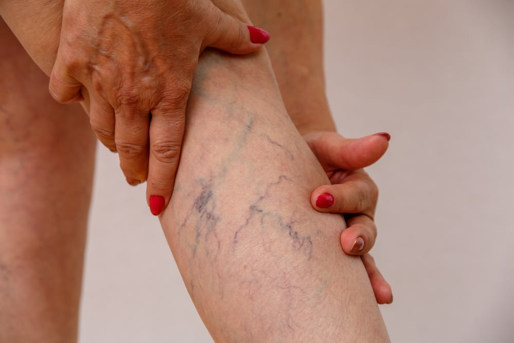 Redness & Vascular