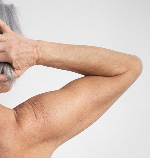 Skin Laxity