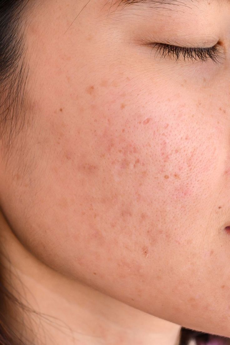 Post-Acne Skin