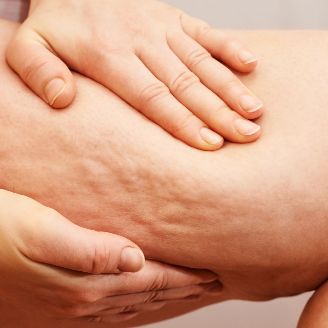 Cellulite Appearance