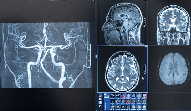 Whole-Body MRI